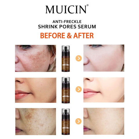 MUICIN - Anti Freckle Shrink Pores Serum - Clear & Confident Complexion