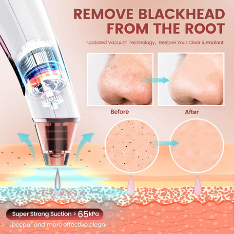 Home.Co - Blackhead Remover Vacuum